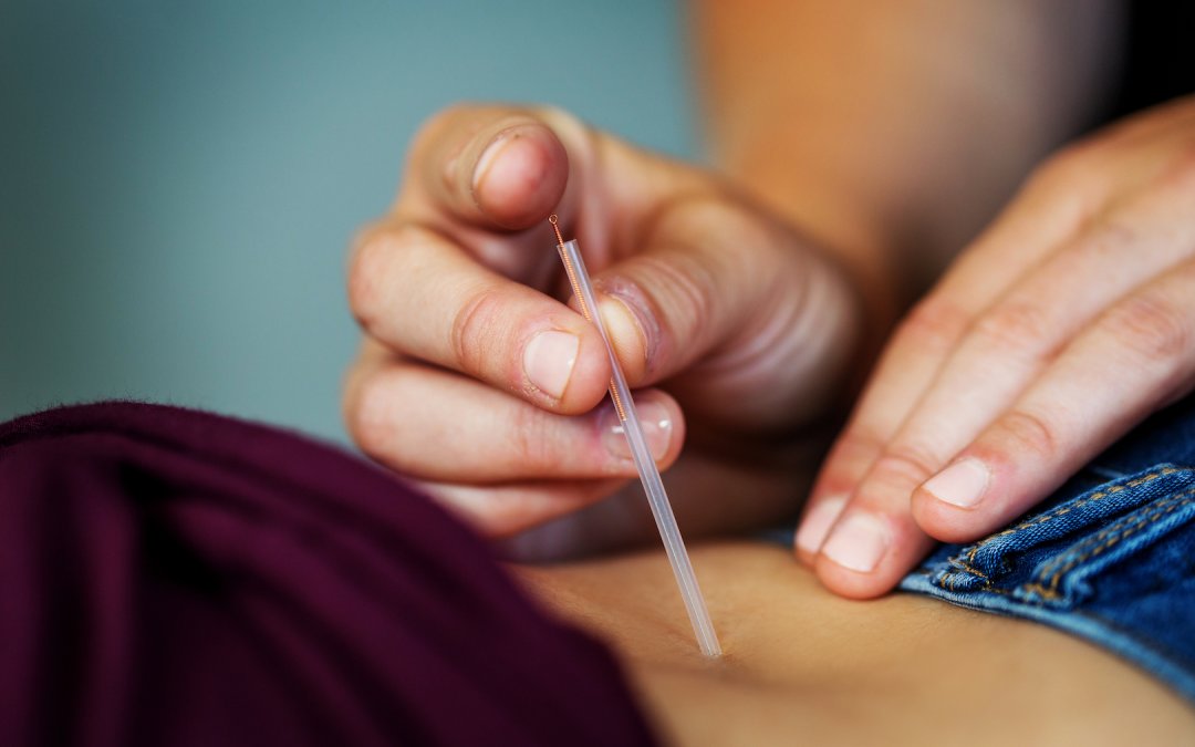 Acupuncture