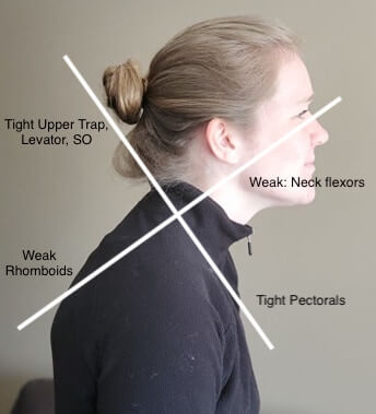 Upper Crossed Syndrome Poor Posture at Desks and Device use